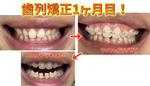 【写真あり】矯正1ヶ月目のリアル体験談｜痛み・食事・見た目の変化は？